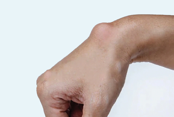 Lipoma