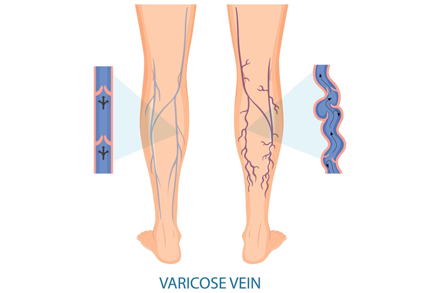 Laser Varicose Vein Surgery