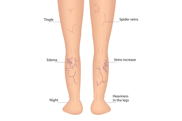 Varicose Veins