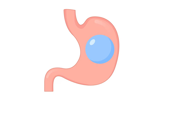 Intra Gastric Balloon
