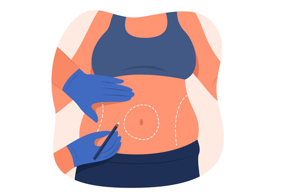 Weight Loss Surgery