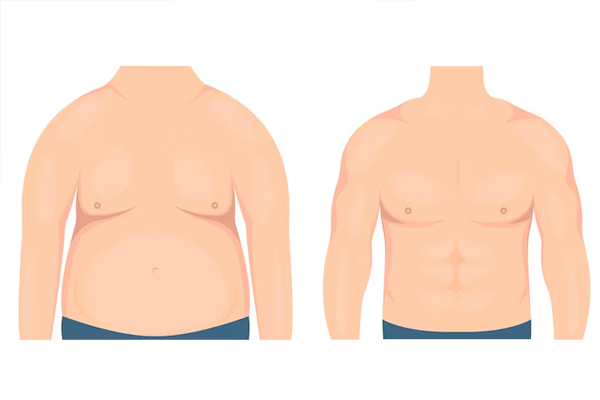 Gynecomastia